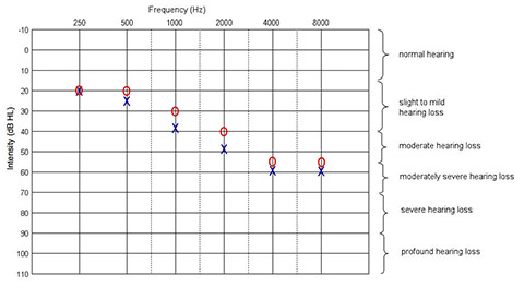 Hearing Chart with high frequency hearing loss Hearing Chart with high frequency hearing loss